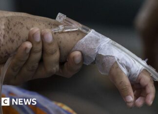 Hundreds of children die within months as measles cases soar in Bangladesh